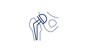 Joint Replacement